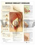 Benign Breast Disease Anatomical Chart